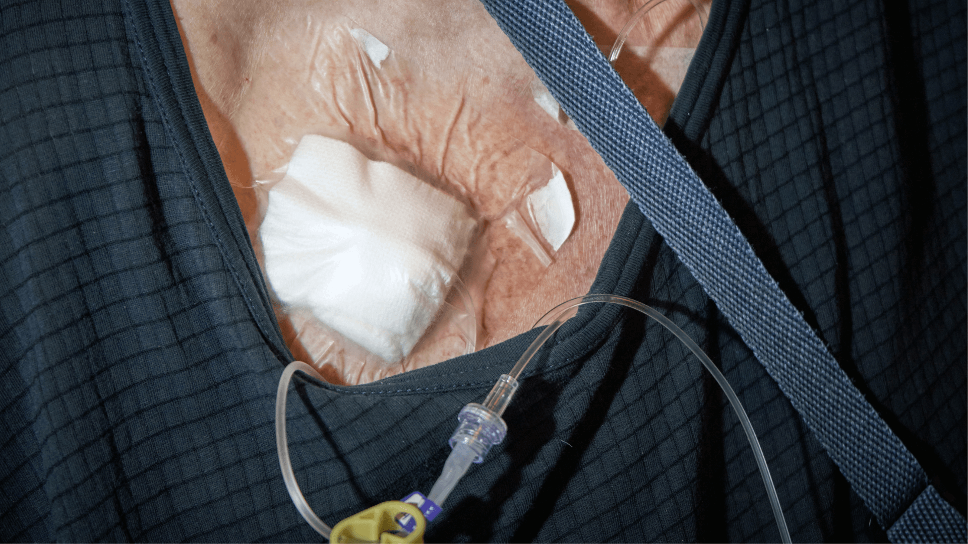 Bard Port Catheter Case Review – Deyden Solutions